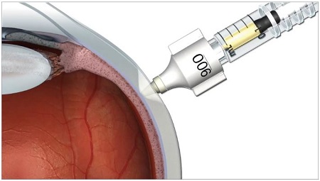 US FDA Approves Xipere for Suprachoroidal Use in Macular Edema with ...