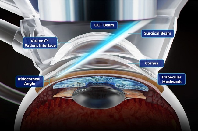 AAO and Eyecelerator Sessions Showcase  Latest in Glaucoma Lasers and Surgical Devices