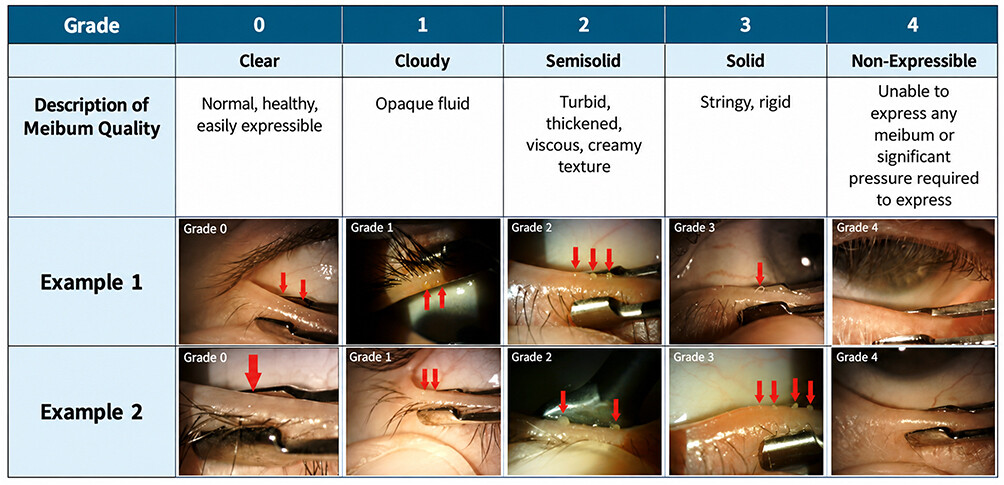 Researchers Develop New Standardized Grading System for MGD